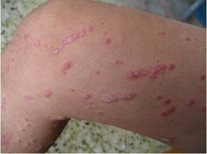 如何缓解牛皮癣患者睡眠不足的危害  