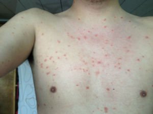 牛皮癣扩散后应该怎么办？ 