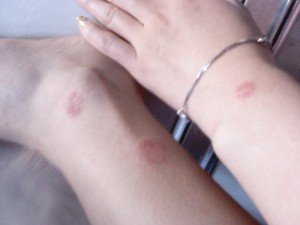 积极的心态能否帮助牛皮癣的治疗 
