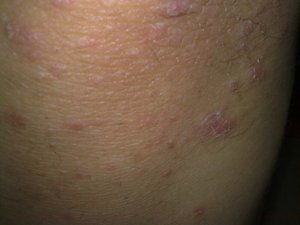 女性牛皮癣患者要预防过敏 