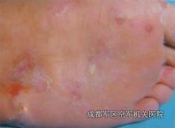 寻常型牛皮癣