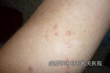 牛皮癣预防