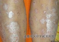 牛皮癣危害