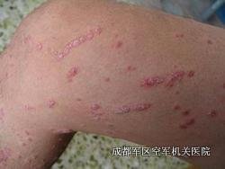 寻常型牛皮癣