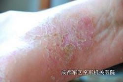 牛皮癣诊断