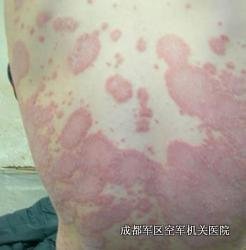 牛皮癣预防