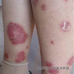 牛皮癣诊断