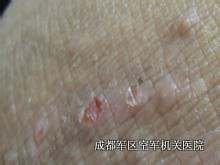 牛皮癣诊断