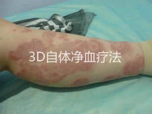 银屑病怎么根治